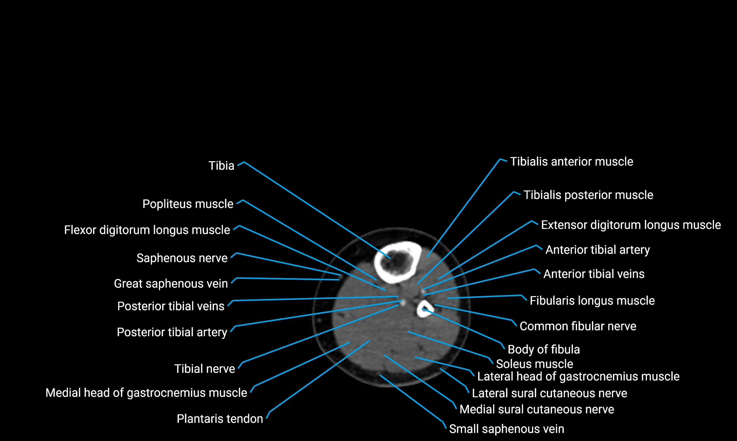 CT lower limb axial cross sectional anatomy labelled image 104 (2).webp